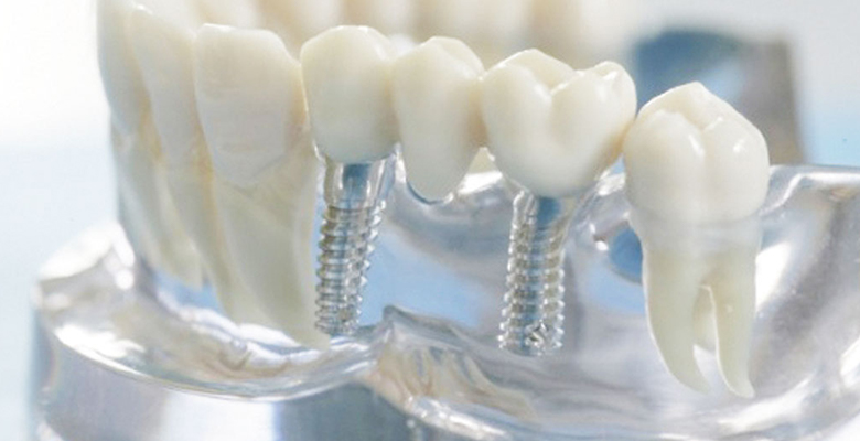 Zahnimplantate / Implantologie
